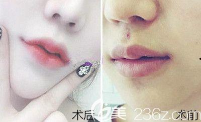 削唇手术前后照片,削唇手术前后惊人变化